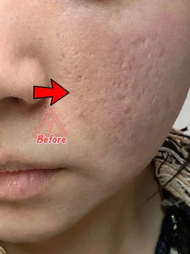 Unisex Acne Scar Repair Cream – Mark Fading & Skin Regeneration Gel