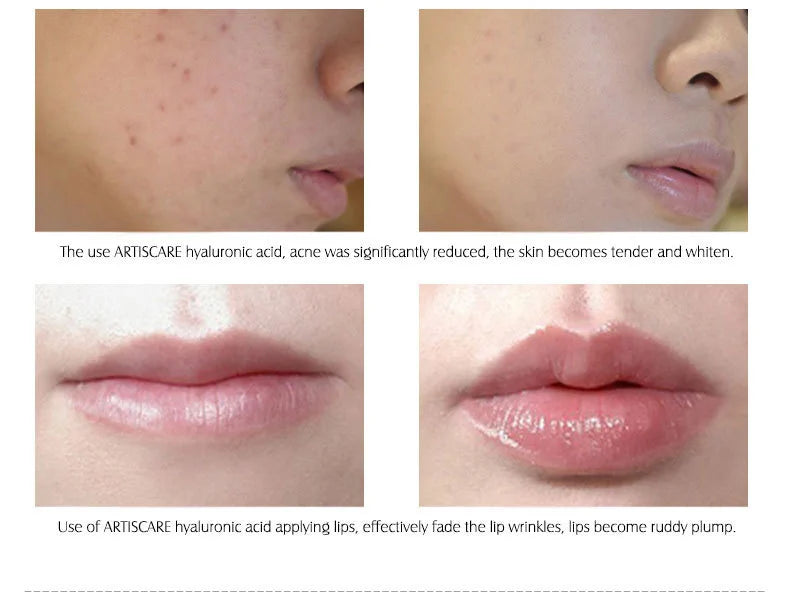 Hyaluronic Acid Serum VC Essence Face Cream Moisturizing Acne Aging & Wrinkles Repair 10PCS