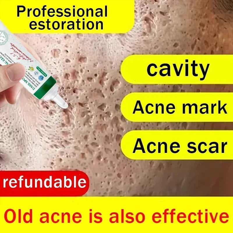 Unisex Acne Scar Repair Cream – Mark Fading & Skin Regeneration Gel