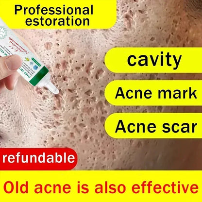 Unisex Acne Scar Repair Cream – Mark Fading & Skin Regeneration Gel